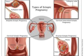 Management Of Ectopic Pregnancy